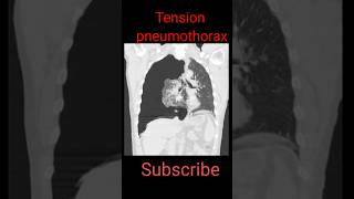 Tension Pneumothorax shorts radiological education chestpathology [upl. by Harned]