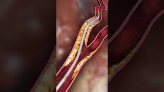 Carotid embolic prevention  animationshorts shortsfeed youtubeshorts viralshorts [upl. by Ansev]