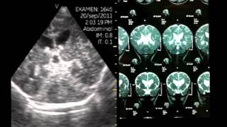 VSCAN Pocket Ultrasound Transfontanelar Hydrocephalus Hidrocefalia [upl. by Adnilav529]