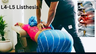 HOW TO TREAT BACKPAINL4L5 Anterolisthesis Best Chiropractor in India Immediate relief [upl. by Chiles]