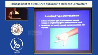 Management of established Volkmanns Ischemic Contracture [upl. by Notnats445]