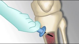 quotPlacement of an Intraosseous Linequot by Monica Kleinman MD for OPENPediatrics [upl. by Genna]