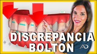 👩🏻‍⚕️Discrepancia de BOLTON👨🏻‍⚕️Analisis de la discrepancia de BOLTON en ORTODONCIA [upl. by Bashee]