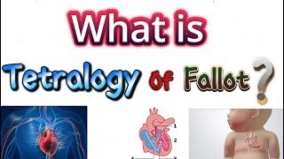 Tetralogy of fallot [upl. by Oniuqa]