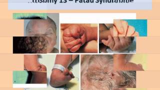 Approach to a Newborn with Dysmorphic FeaturesDr Prakash Manikoth FRCPCH [upl. by Enrobialc]