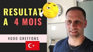 Greffe de cheveux FUE en Turquie Vidéo 12  Résultat à 4 mois  4000 Greffons [upl. by Aurthur800]