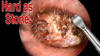 BIGGEST Ear Wax Difficult Removal  EP2  Doctor Anh [upl. by Lipp]