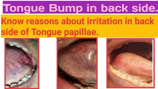 Tongue bumpTongue papillae increase in sizeBurning sensation in side of Tongue Bump know regions [upl. by Landon]