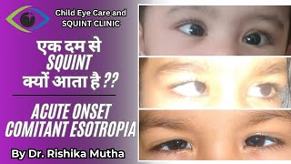 Best squint surgery in india  squint surgery in india [upl. by Dlanor614]