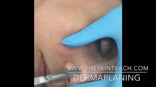 Dermaplaning Technique Face Nose and Mouth [upl. by Hurwit287]