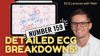 EKG Test Yourself  ECG Case Study 159 [upl. by Acimehs]