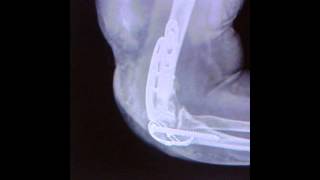 DISTAL INTERCONDYLAR HUMERUS FRACTURES ORIF DR PUNIT KUMAR JAIN [upl. by Nonnair]