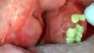 big tonsils stones removal tonsilolith removal big hidden tonsils stone removal [upl. by Lombardo127]