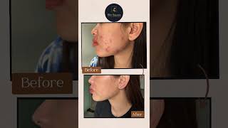 See the Transformation at Skin Square Clinic 🌟 [upl. by Adran]