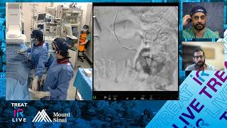 Transradial Embolization of Multiple Renal Angiomyolipomas using LAVA Liquid Embolic System [upl. by Liss586]