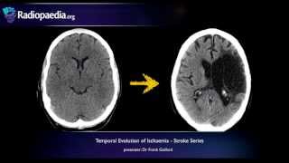 Stroke Evolution from acute to chronic infarction  radiology video tutorial CT MRI [upl. by Attenborough541]