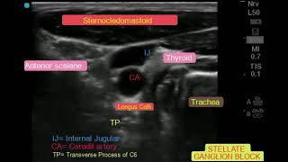 Ultrasound Guided Stellate Ganglion Block for Long COVID [upl. by Imeka]