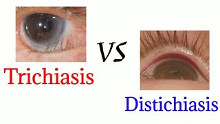 Difference between trichiasis and distichiasis  optometry club [upl. by Namzaj]