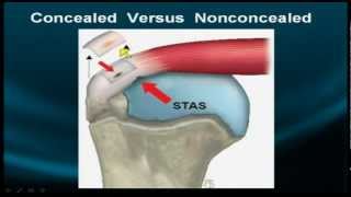 Shoulder MRI Rotator Cuff  Part IIa [upl. by Lorolla]