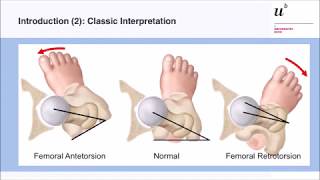 M Tannast In amp outtoeing a reliable diagnostic sign for femoral malversion Hip Symposium 2018 [upl. by Talbott]