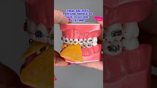 BEST CHIPS SNACKS TO EAT WITH BRACES ON 🦷 Orthodontist Reacts to Cheese Puffs Satisfying Food ASMR [upl. by Acsirp628]