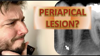 How to Identify a Periapical Radiolucency Abscess Cyst Granuloma Root canal infection x rays [upl. by Anayik179]