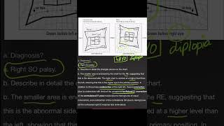 Hess Chart  Superior Oblique Palsy [upl. by Eedyak]