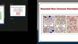 Non Immune Hemolytic Anemia Prof Dr Naglaa Shaheen [upl. by Niels443]