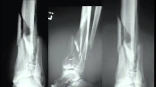 Pilon Fractures Management Options [upl. by Akcirahs690]