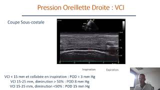 Evaluation de la fonction diastolique en échocardiographie transthoracique [upl. by Keel]