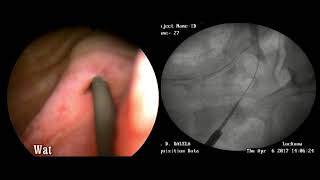 Fluoro endoscopic diagnosis and management of ureterovaginal fistula [upl. by Gnort]