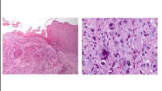 Laryngeal Cancer [upl. by Cohn]