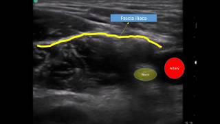 Ultrasound guided fascia iliaca compartment block  labelled [upl. by Eema728]