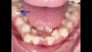 Lower Incisor Extraction Time Lapse Video Kyger Orthodontics [upl. by Ohnuj330]