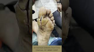 Diabetic Foot Before After Treatment shorts [upl. by Ronacin]