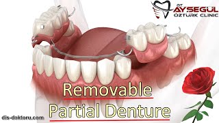 Removable Partial Denture [upl. by Carita]