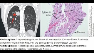 Nekrotisierende sarkoide Granulomatose [upl. by Alekram]