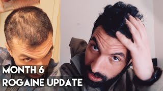 6 Month Rogaine Results Minoxidil [upl. by Anyale972]