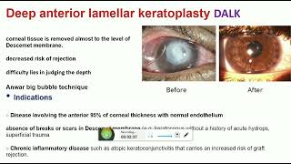 keratoplasty part 2 [upl. by Wendelina]