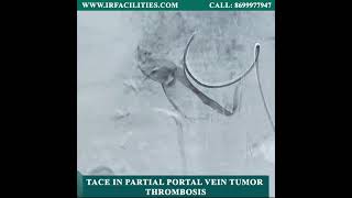 TACE in Partial Portal Vein Tumor Thrombosis  IRFACILITIES [upl. by Saylor]