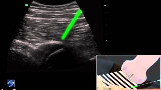 How To Hip UltrasoundGuided Injection of the Proximal Hamstring 3D Video [upl. by Amihc583]