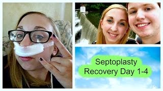 Septoplasty Recovery Day 14 [upl. by Phonsa185]