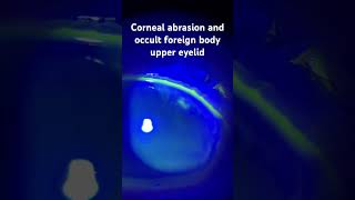 Corneal abrasion and occult foreign body under the upper eyelid protectingsight ophthalmology [upl. by Patterson]