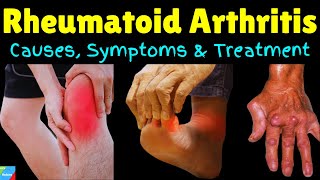 Rheumatoid Arthritis – Signs amp Symptoms Causes Diagnosis Treatment Complications [upl. by Polivy]