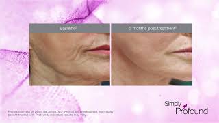 Profound RF Microneedling NonSurgical Facelift Long Island Manhattan NYC [upl. by Nehtanoj339]