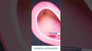 Operative Hysteroscopy  Fibroid amp Polyp removal  Hysteroscopic polypectomy  Types of Hysteroscope [upl. by Yeltnarb528]