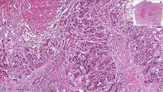 Hepatocellular Carcinoma  Histopathology [upl. by Wolfort]