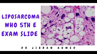 LIPOSARCOMA II WHO 5TH E II EXAM SLIDE II SIMPLY PATHOLOGY II SOFT TISSUE TX II DR JIBRAN AHMED [upl. by Finbur]