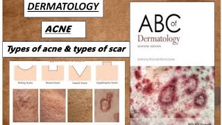 DERMATOLOGY ACNE types of acne and scar derma acne scar [upl. by Akema]