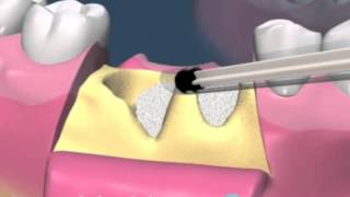 Animație  Extracție dentară  adiție osoasă  implant dentar [upl. by Maltz]